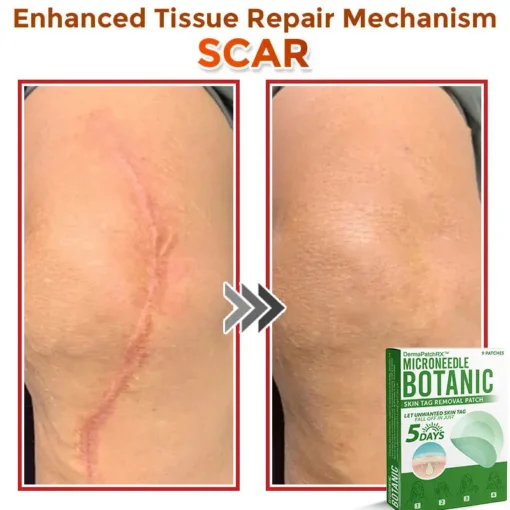 DermaPatchRX® MicroNeedle Botanic Skin Tag Removal Patch