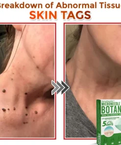 DermaPatchRX® MicroNeedle Botanic Skin Tag Removal Patch