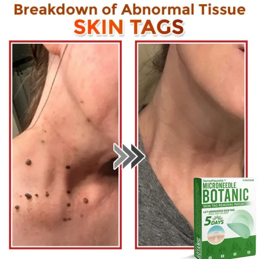 DermaPatchRX® MicroNeedle Botanic Skin Tag Removal Patch