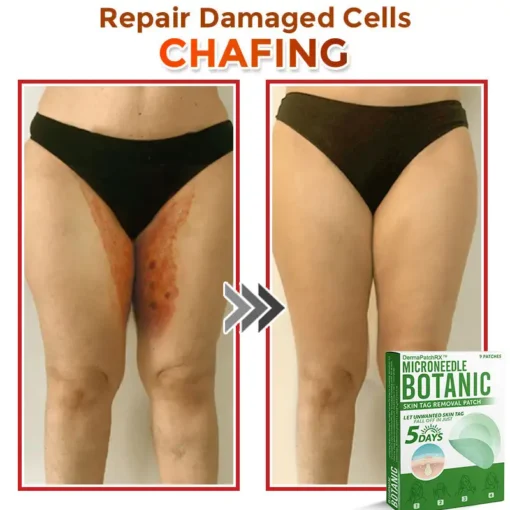 DermaPatchRX® MicroNeedle Botanic Skin Tag Removal Patch