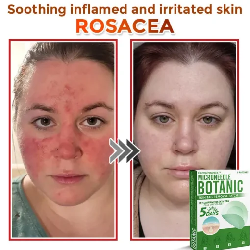 DermaPatchRX® MicroNeedle Botanic Skin Tag Removal Patch
