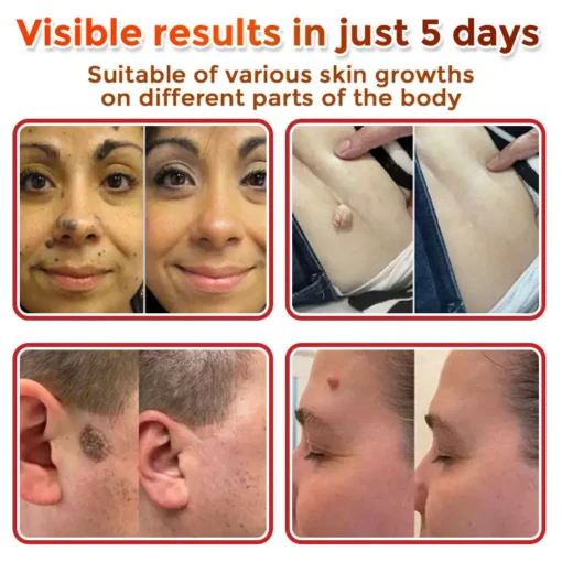 DermaPatchRX® MicroNeedle Botanic Skin Tag Removal Patch