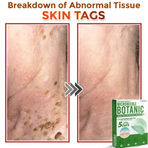 DermaPatchRX® MicroNeedle Botanic Skin Tag Removal Patch