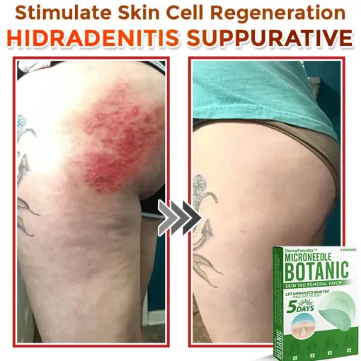 DermaPatchRX® MicroNeedle Botanic Skin Tag Removal Patch
