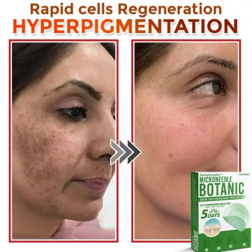 DermaPatchRX® MicroNeedle Botanic Skin Tag Removal Patch