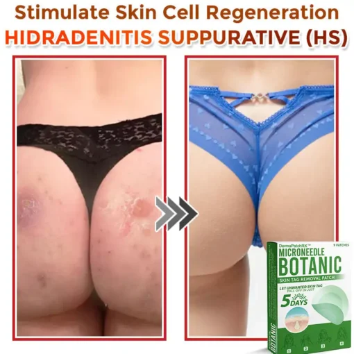 DermaPatchRX® MicroNeedle Botanic Skin Tag Removal Patch