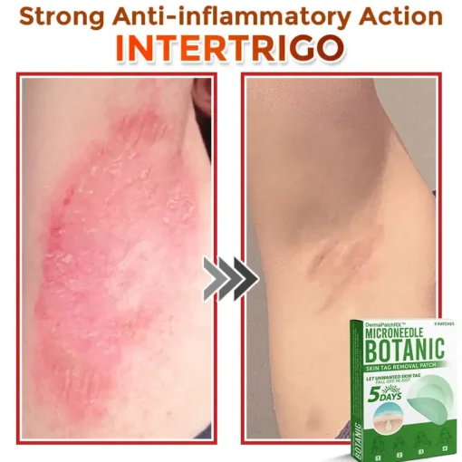DermaPatchRX® MicroNeedle Botanic Skin Tag Removal Patch