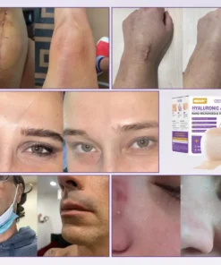 NEGUSY® Hyaluronic Acid Nano Microneedle Repair Tape