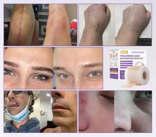 NEGUSY® Hyaluronic Acid Nano Microneedle Repair Tape