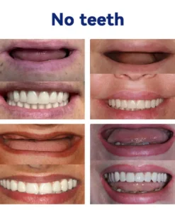 NEGUSY™ Silicone Denture Ruler Set