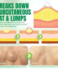 NEGUSY™Advanced Lipoma & Nodule Treatment Cream