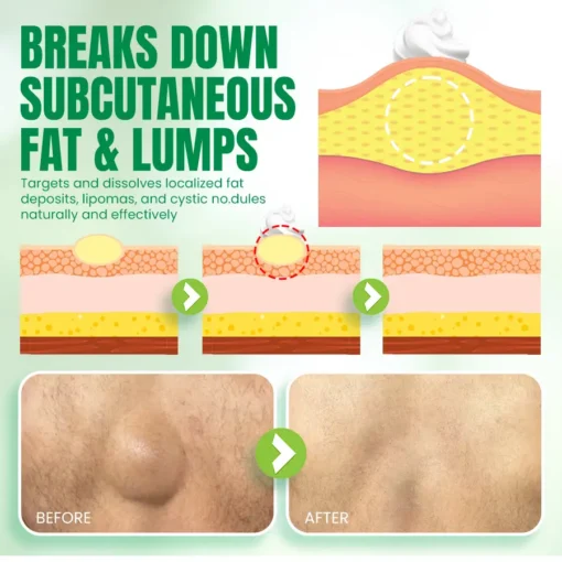 NEGUSY™Advanced Lipoma & Nodule Treatment Cream