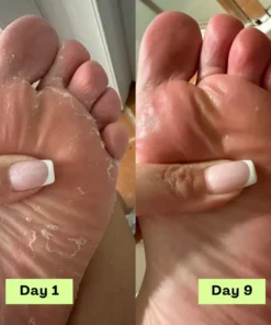 NEGUSY™ Tea Tree Athlete's Foot Defense Soap